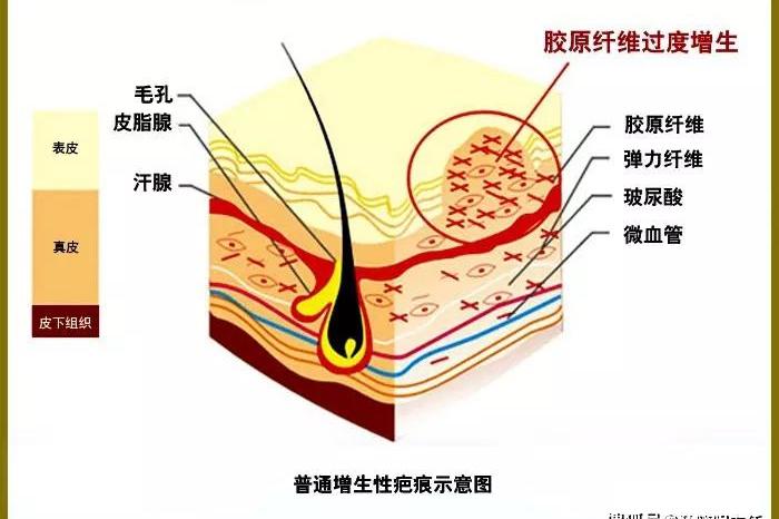 纤维组织增生图片