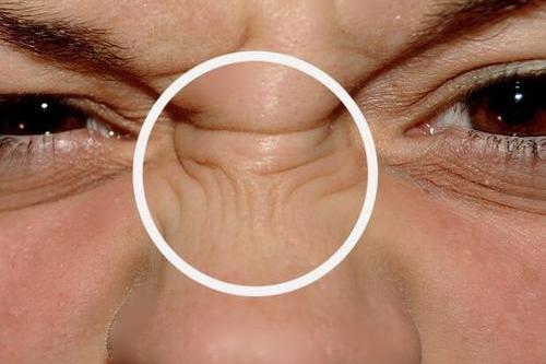 鼻子为什么会出现皱纹?该如何进行治疗?_皮肤
