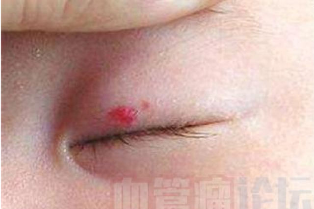 眼部血管瘤有哪几种类型?有什么治疗方法?_患者