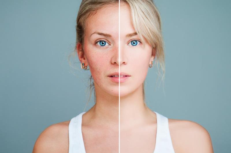 晓磊老师分享:祛斑美白不成功?那是因为这件事没做好!