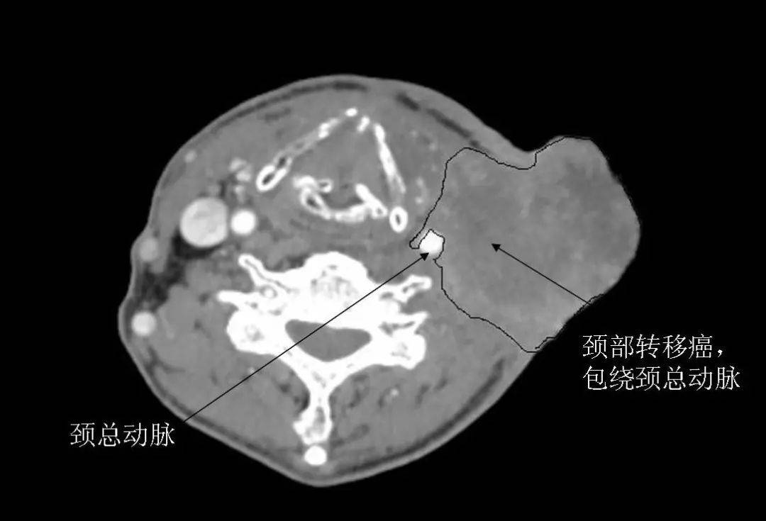 喉癌晚期患者颈部复发、溃烂，于振坤专家团队巧用胸部肌肉皮肤，成功挽救患者生命-搜狐大视野-搜狐新闻