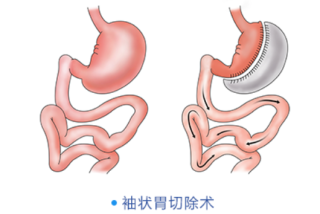 靠切胃手術來減肥,可靠性如何?