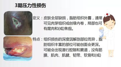 面对压疮不要慌,护理小妙招帮你忙!-搜狐大视野-搜狐新闻