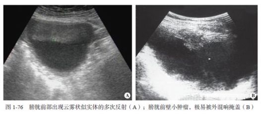 【超声微课堂】16种常见超声伪像的识别和避免方法(灰阶超声篇)-搜狐大视野-搜狐新闻
