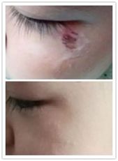 磕伤、碰伤、擦伤,学会这招让伤口快速愈合!-搜狐大视野-搜狐新闻