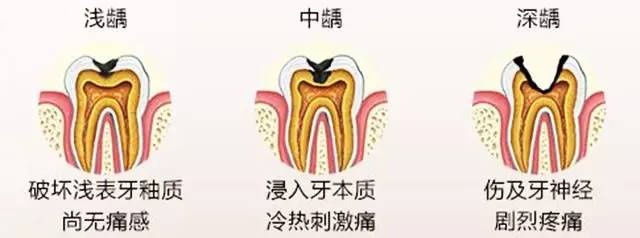 能仅从表面判断龋齿的严重程度,牙洞的大小有时并不是我们看到的样子