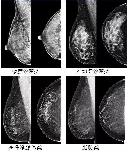 乳腺癌乳房图片 外观图片