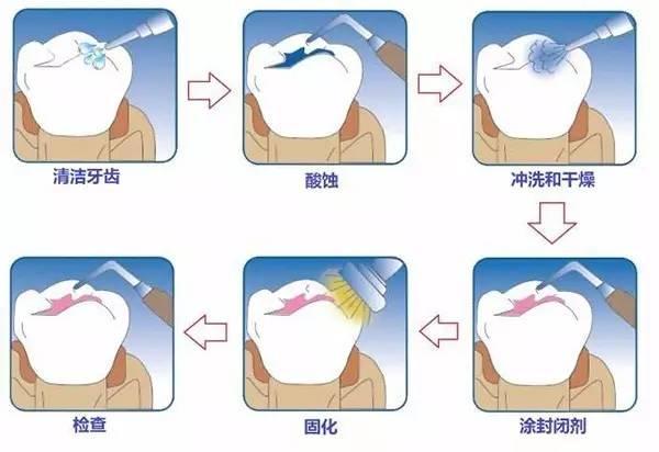 窝沟封闭步骤通过流动性树脂材料对窝沟的封闭保护,使牙齿免受食物和