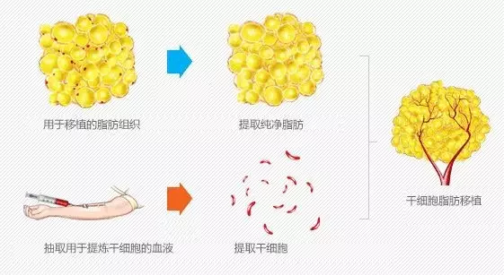 然后与其它脂肪进行混合,在填充脂肪时加入经处理的脂肪干细胞