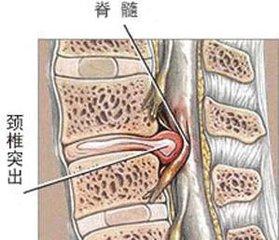 颈椎突出怎样改善