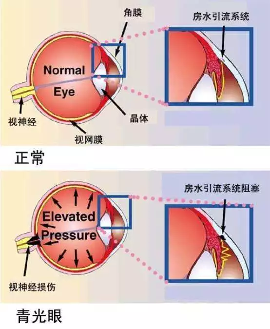 青光眼5大症状图片