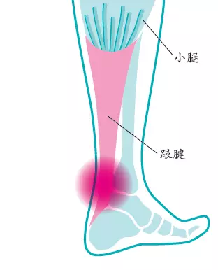 病理:跟腱是由连接小腿后方肌群与跟骨的带状肌腱纤维组成,张力通过