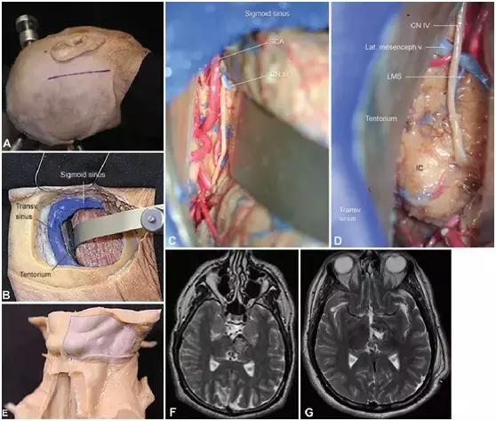 腦幹手術13個安全操作區和10種手術入路詳解