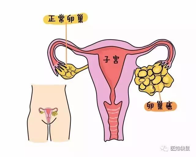 江淮晨报网身体出现这6个信号别不在意,当心是卵巢癌的警告