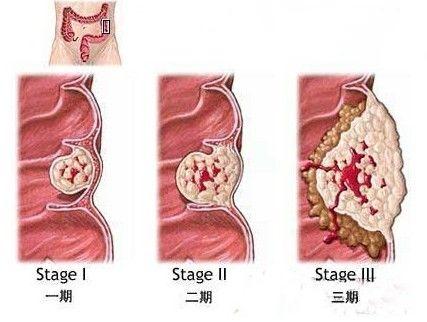 男性長痔瘡的具體症狀圖片