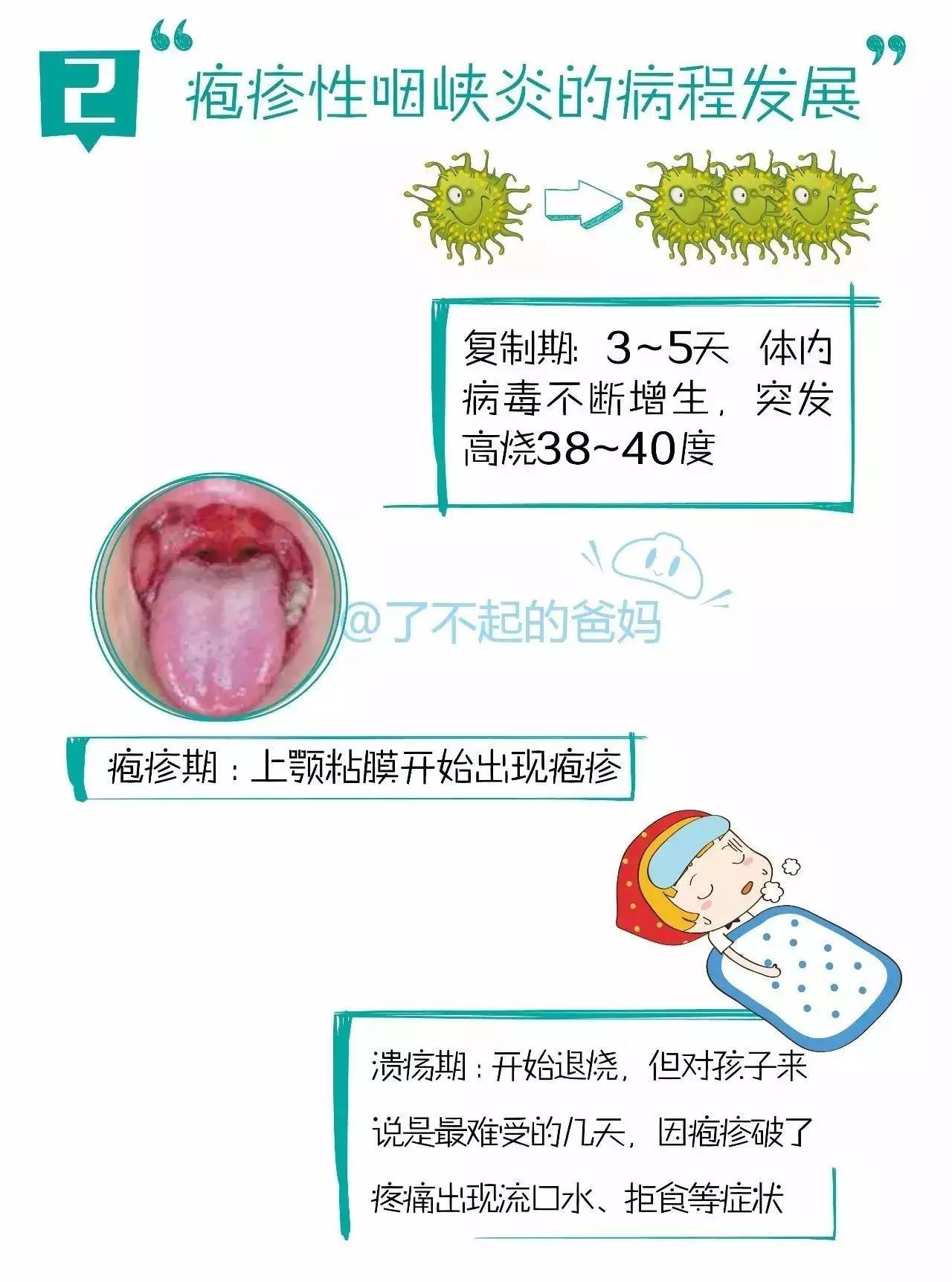 疱疹性咽峡炎手足口病图片