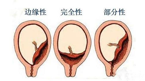 b超检查显示胎盘位置低很危险孕妈如何正确保胎
