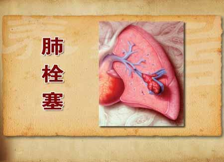 肺动脉硬化的病因是什么？