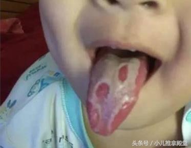 地图舌花剥苔有什么区别 明白了 宝妈就不紧张啦