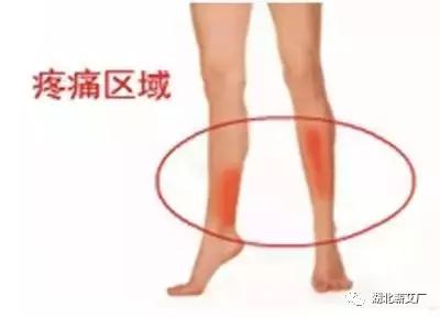 小腿水肿后果很严重——警惕下肢静脉血栓!