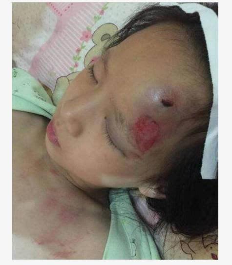 宝妈在医院生二胎,大宝女儿却在家被打的鼻青脸肿