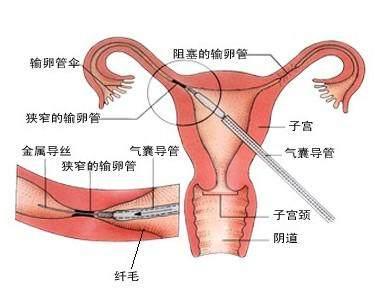 输卵管有粘连