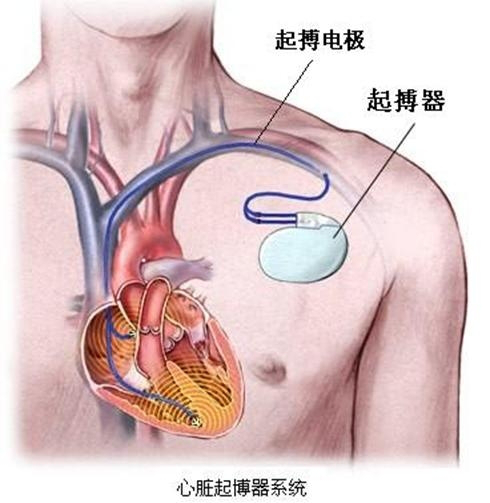 聊聊心脏起搏器与麻醉