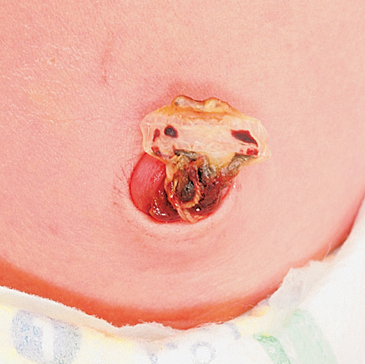 新生儿肚脐长息肉图片图片
