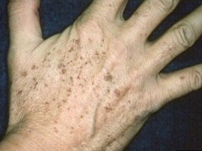 手背处长斑通常是更年期开始长,主要是脂褐素发生的色素沉着,称之为