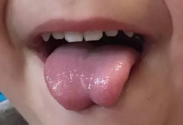 如果舌头伸不出口唇,或伸舌时舌尖呈分叉状或w形状(正常人舌头伸出