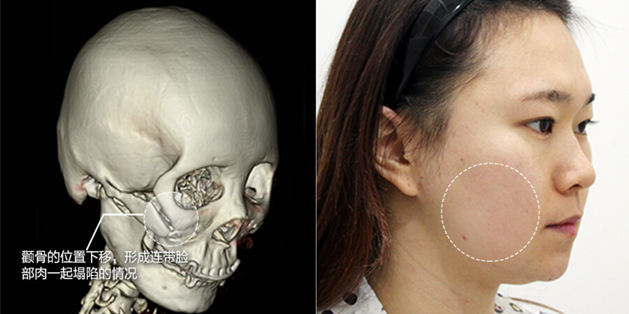 韩国磨骨整形手术会有后遗症吗?