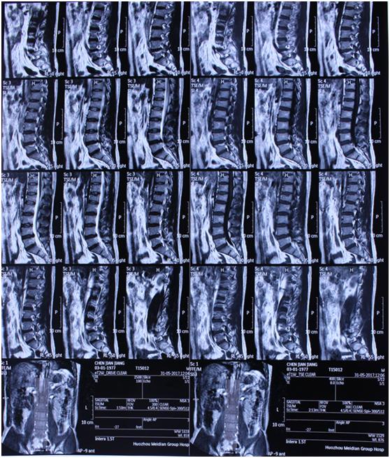 根据患者病史及病情,初步怀疑腰椎间盘突出,建议做影像学检查明确诊断