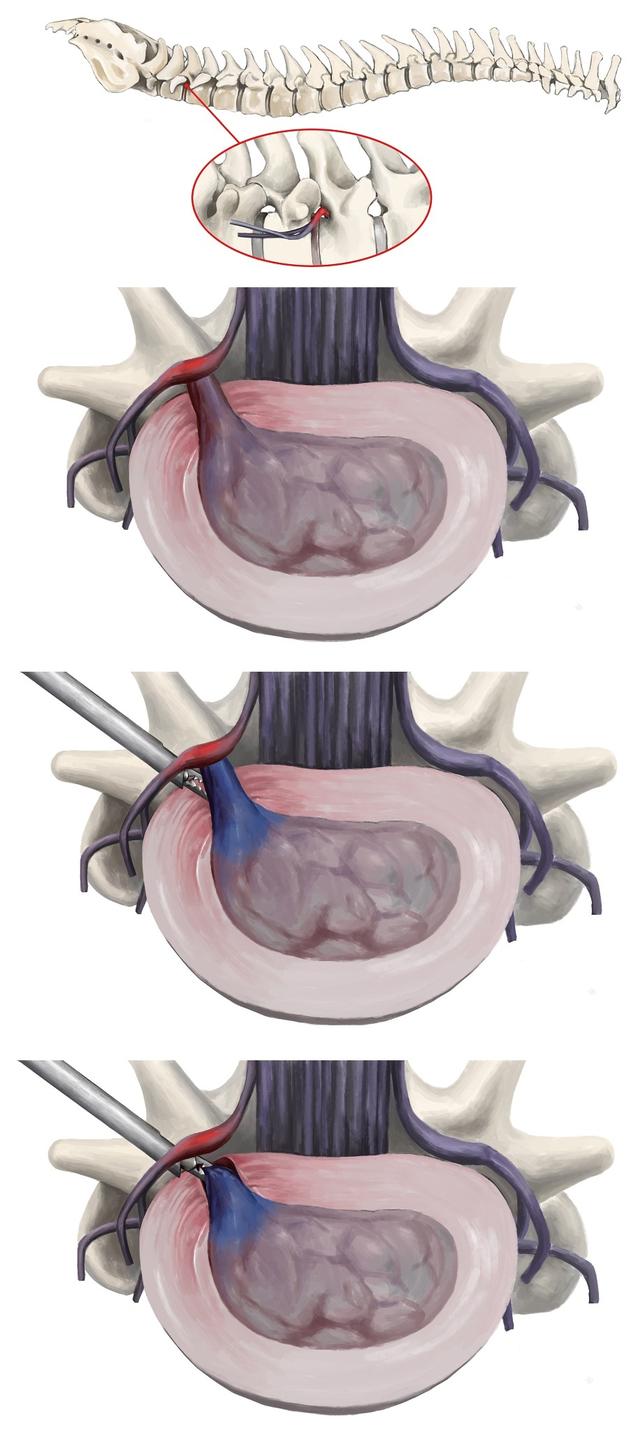 椎間孔鏡技術治療腰45椎間盤突出症一例