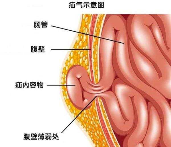 治疝至美:正确认识腹股沟疝