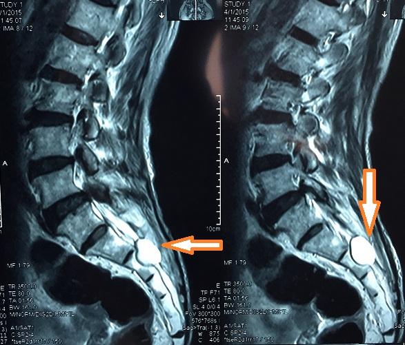 骶管囊肿图片 磁共振图片