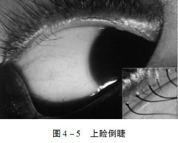 胡继发 倒睫治疗攻略 简单实用