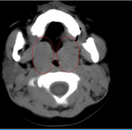 硬腭CT断层图像图片
