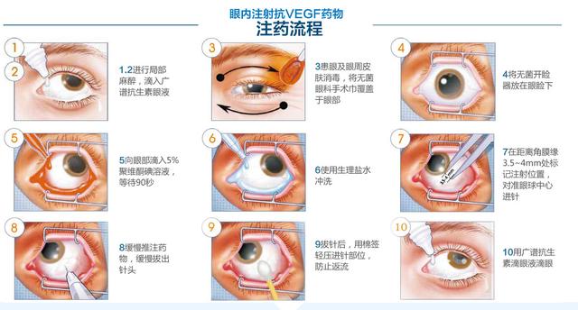 眼科专家详解两个黄斑变性金标准药物