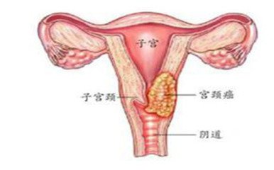 外阴癌是什么症状图片
