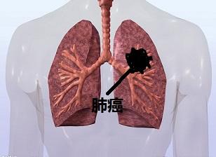 肺癌晚期究竟有多痛苦死前都有这五大症状