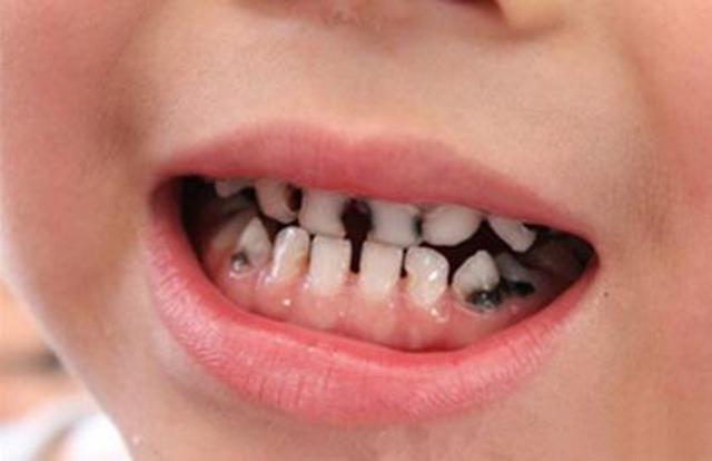 儿童蛀牙严重图片