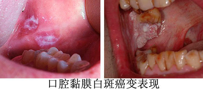 口腔癌早期症状 白点图片