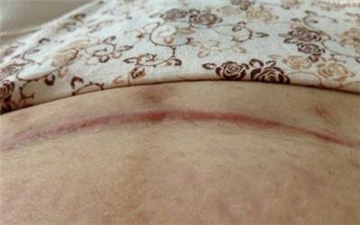 宫腹腔镜疤痕图片