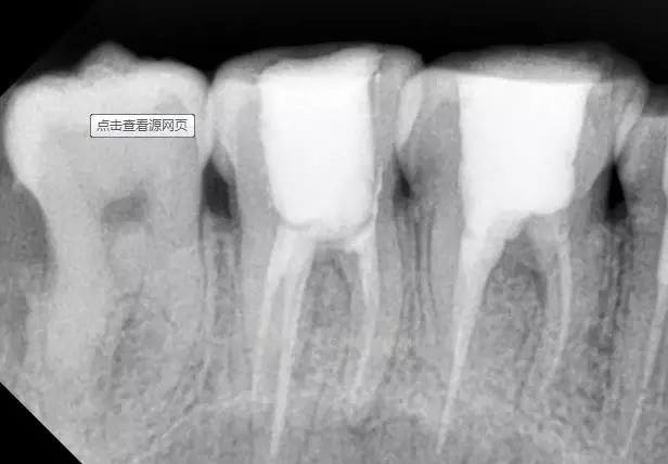 牙髓炎x光片图片