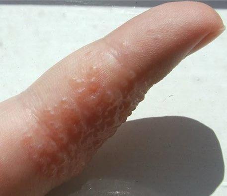 手指上的细菌图片