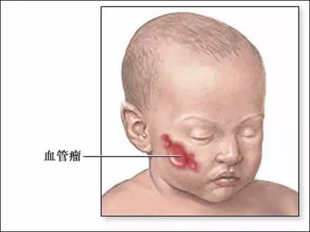 婴儿脸上小红痣图图片