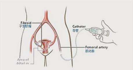 腹腔镜疏通输卵管图片