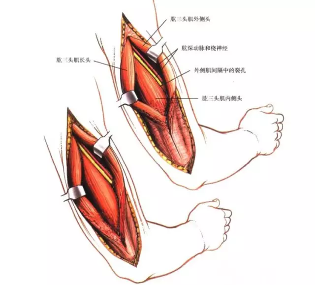 肱三頭肌是由三個頭組成——外側頭,長頭和內側頭.