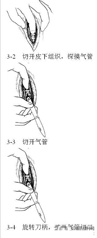 气管切开拔出套管步骤图片