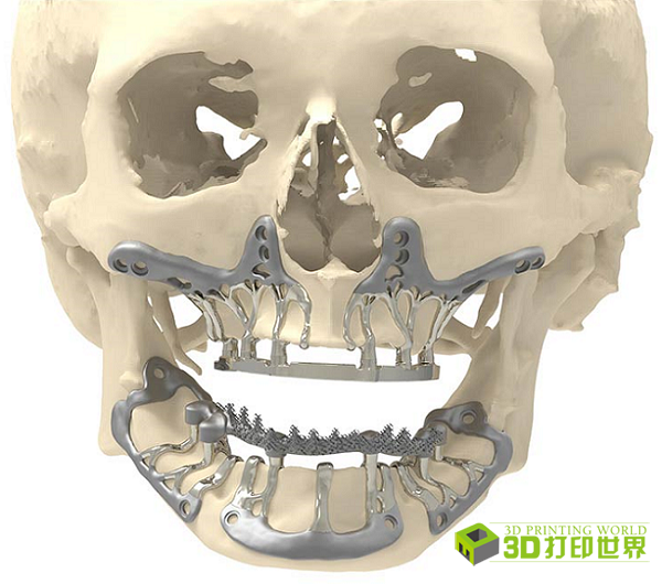 針對骨萎縮的3d打印頜骨鈦植入物,手術只需1小時